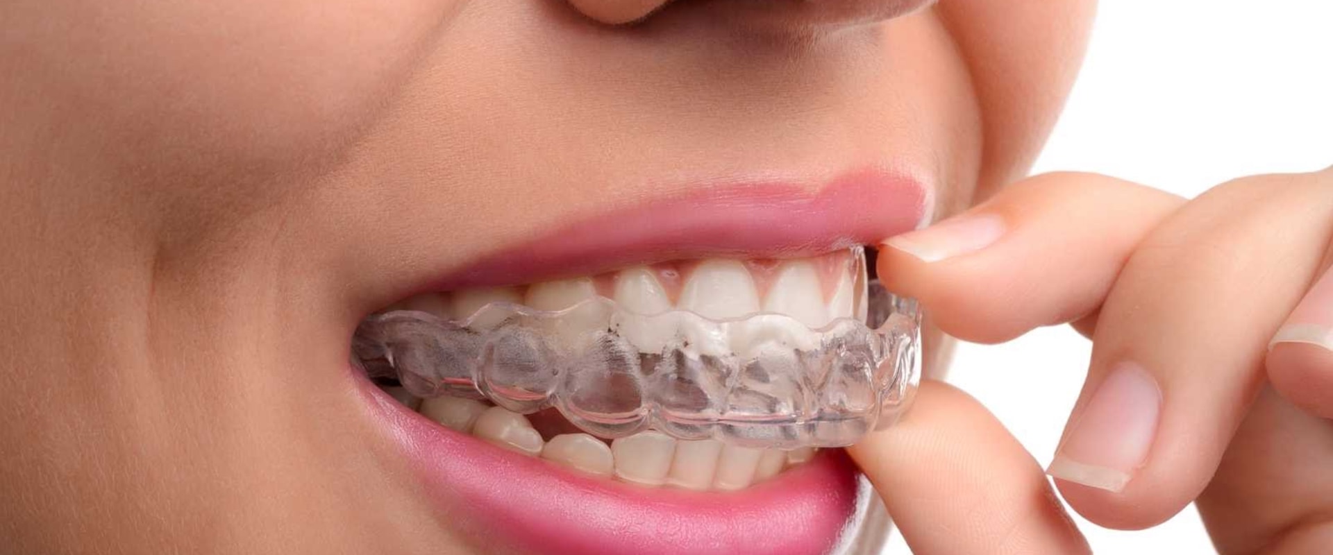 What Foods and Drinks Should I Avoid While Wearing Invisalign Aligners?