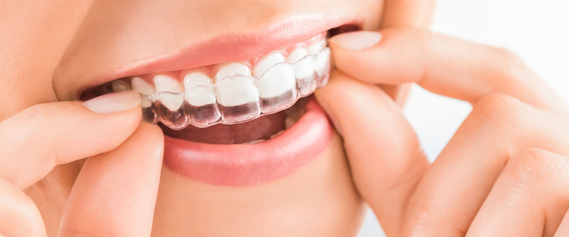 Do I Need Teeth Bonding for Invisalign Treatment?