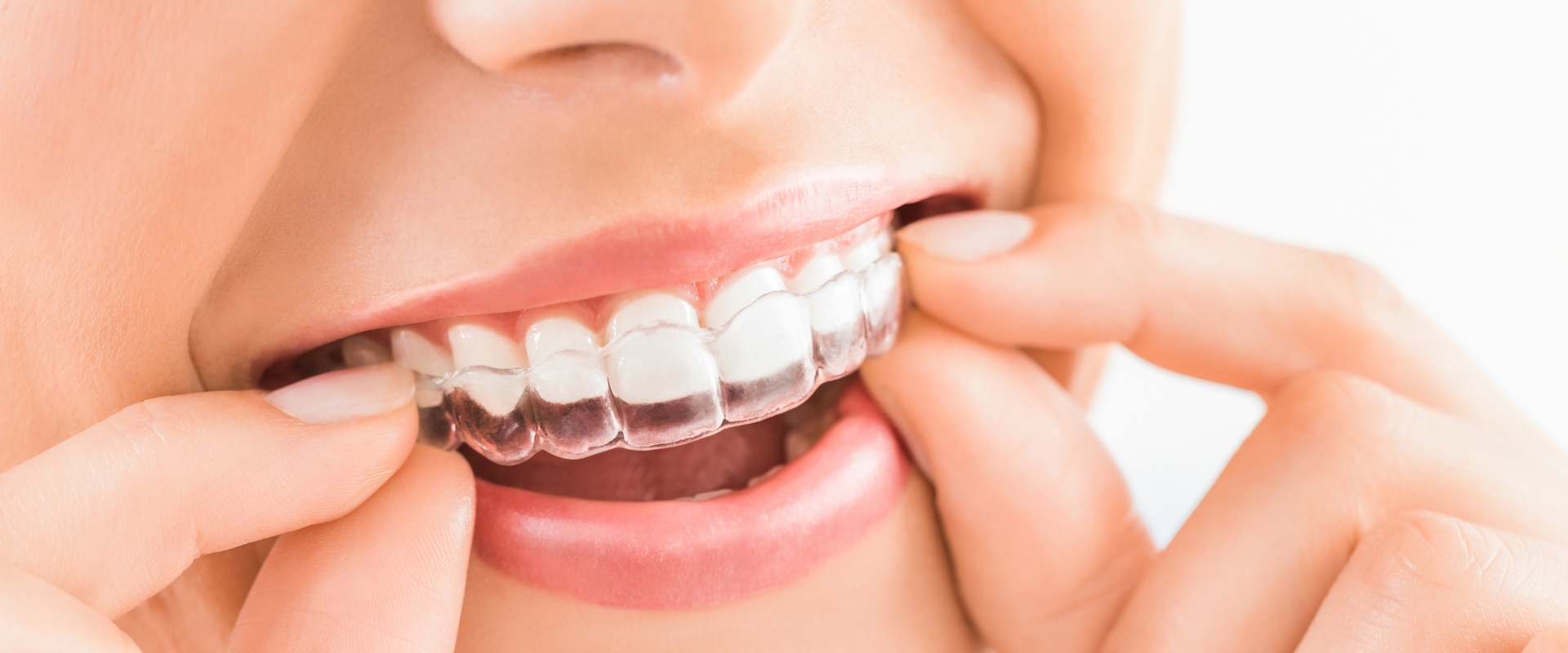 Achieving the Perfect Smile with Invisalign: How Does it Work?