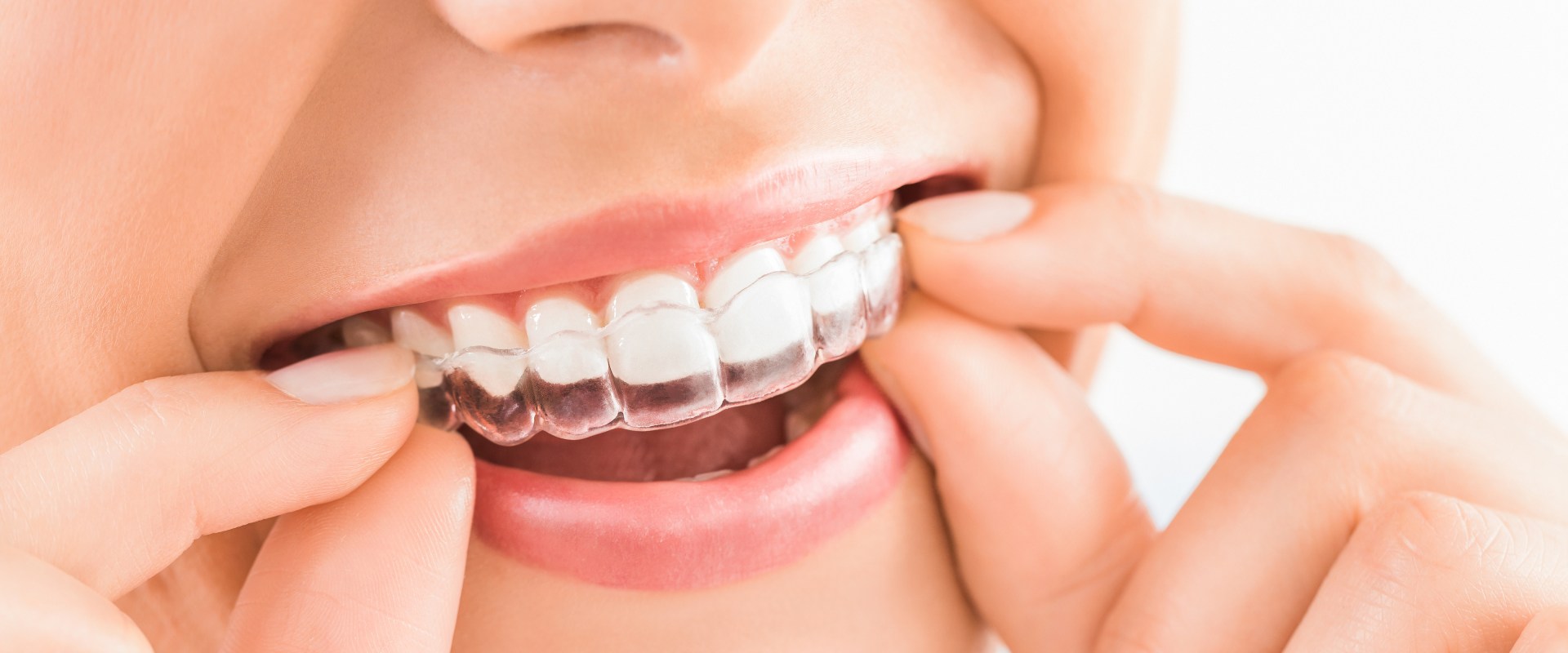 How to Clean Your Invisalign Aligners for Optimal Oral Hygiene