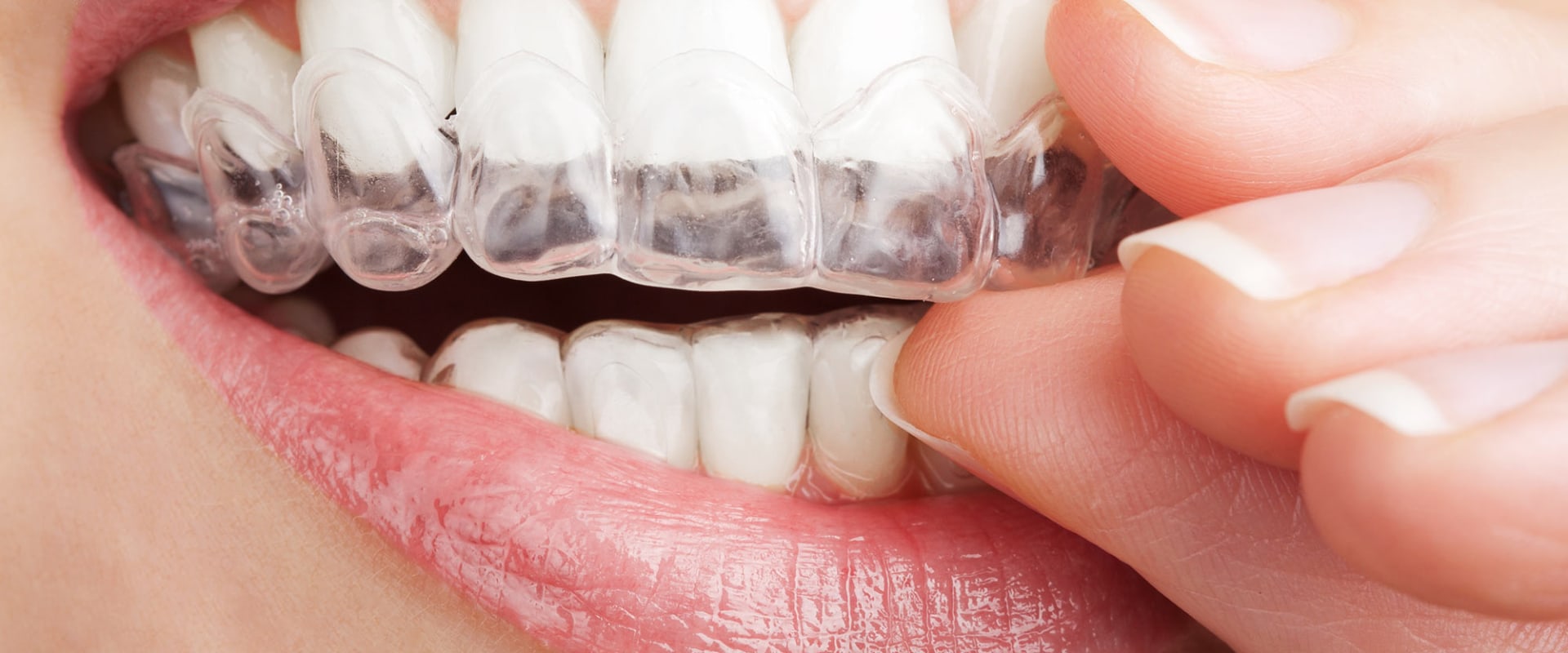 Why You Should Change Your Invisalign Trays Every Two Weeks