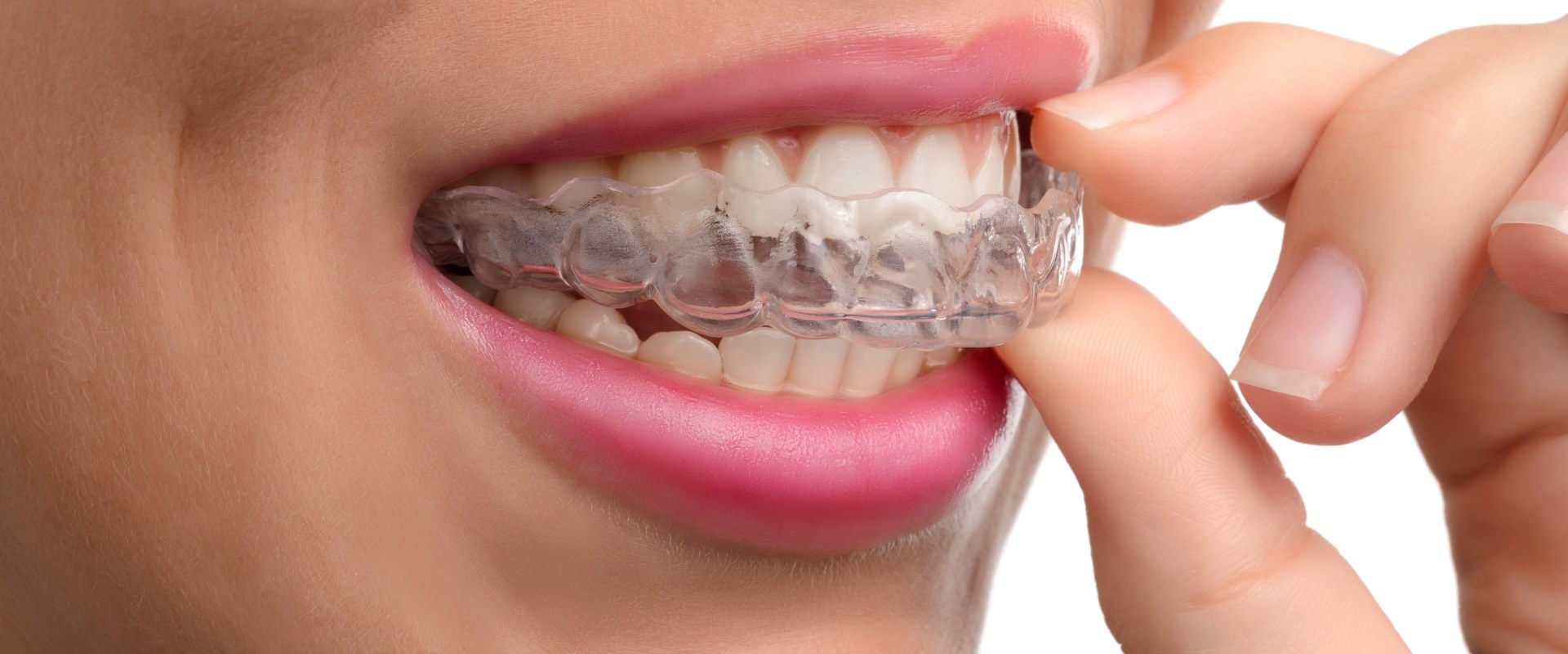 How often Should You Change Your Invisalign Trays?