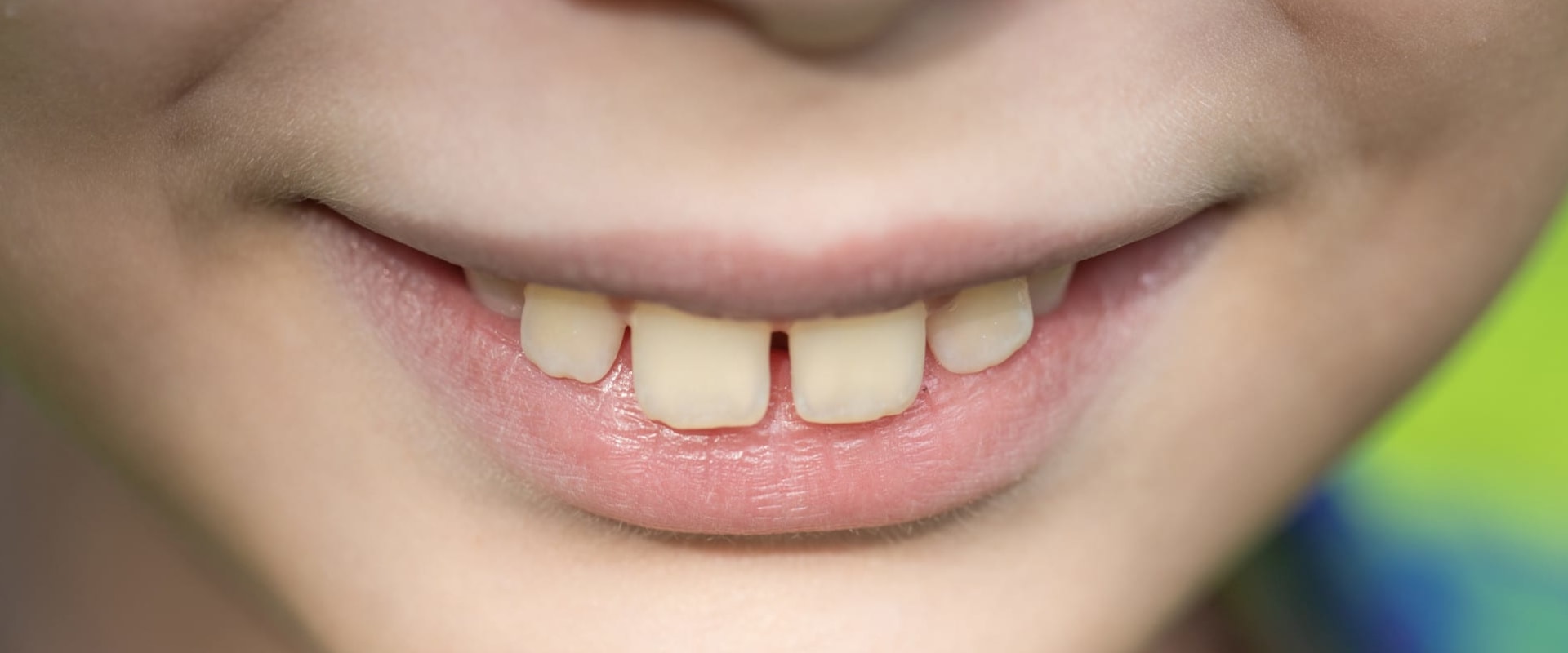 What to Do if Your Teeth Move Out of Place During Orthodontic Treatment