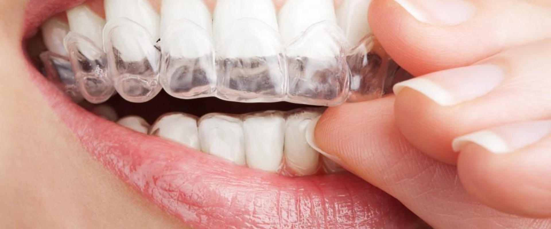 What Activities Should I Avoid While Wearing Invisalign Aligners?