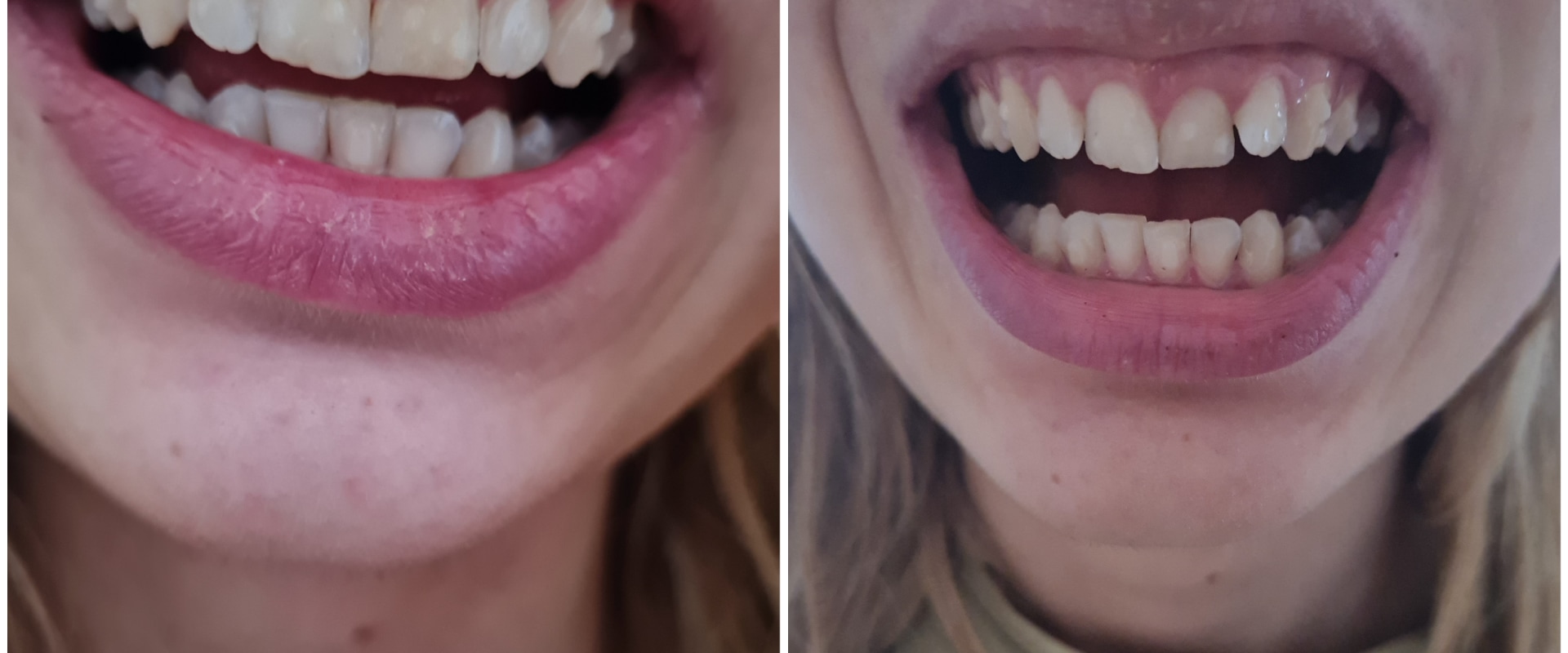 Can I Get a Refund for Unsatisfactory Invisalign Treatment Results?