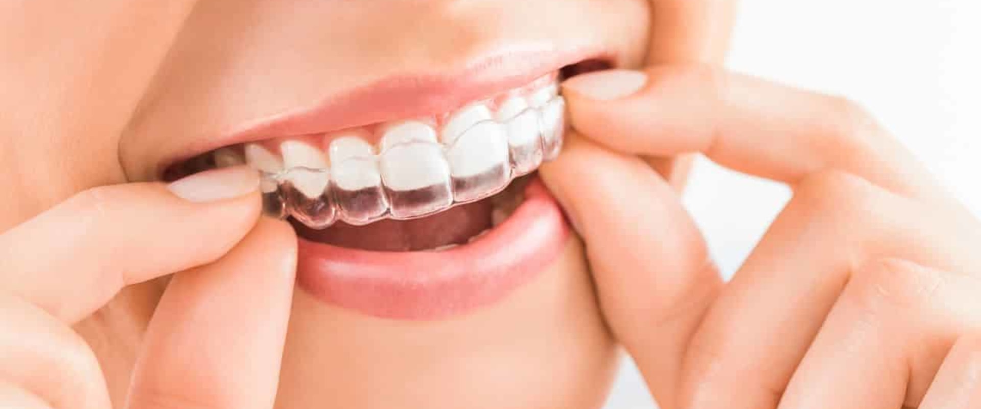 Everything You Need to Know Before Starting Invisalign Treatment