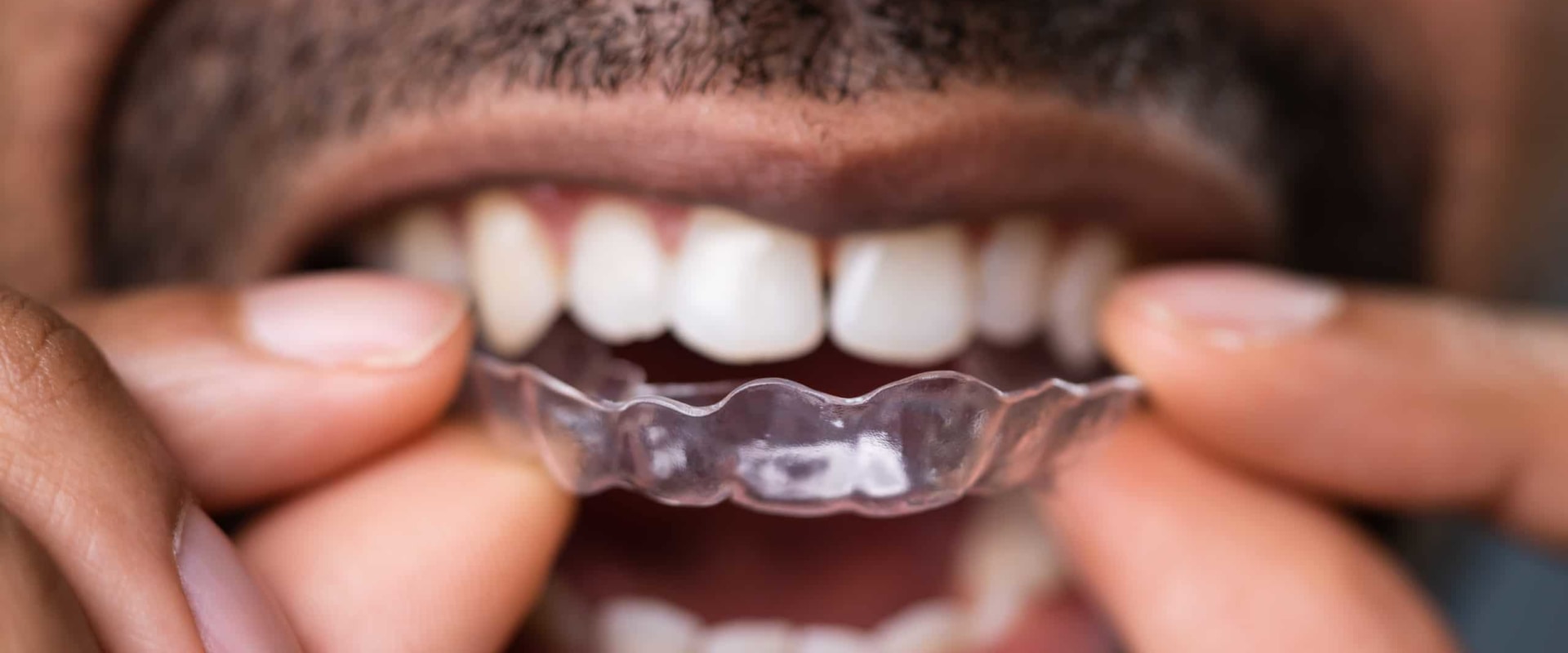 Everything You Need to Know About Invisalign Treatment