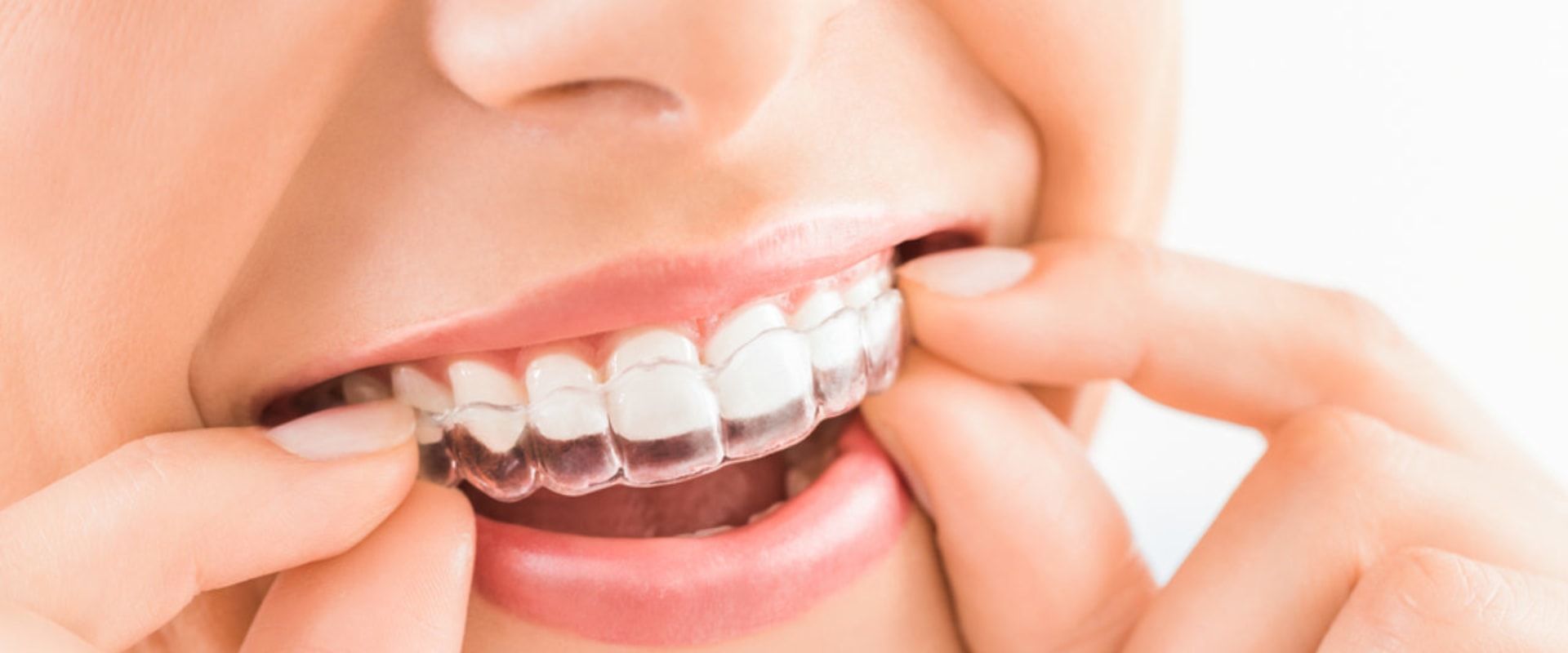 Will Invisalign Affect My Speech? - A Comprehensive Guide