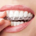 Can I Still Get Invisalign with Periodontal Disease? - An Expert's Perspective
