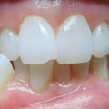Do I Need to Reshape My Teeth for Invisalign Treatment?