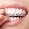How Often Should You Change Your Invisalign Trays?