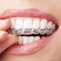 What to Do When Your Invisalign Aligner Breaks
