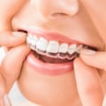 How Long Does It Take to See Results with Invisalign?