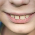 What to Do if Your Teeth Move Out of Place During Orthodontic Treatment