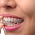 Can Invisalign Fix Crowded Teeth Without Extractions?