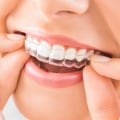 Will Invisalign Affect My Speech? - A Comprehensive Guide