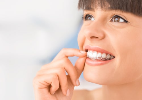 How Long Should You Wear Invisalign Aligners For Optimal Results?