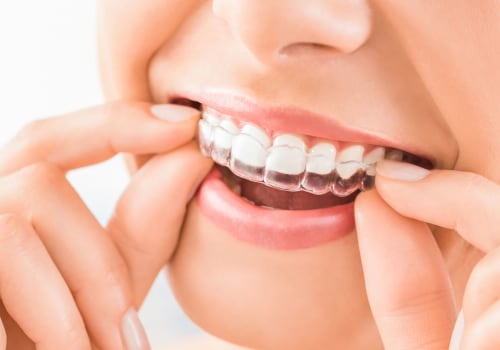 Do I Need Teeth Bonding for Invisalign Treatment?