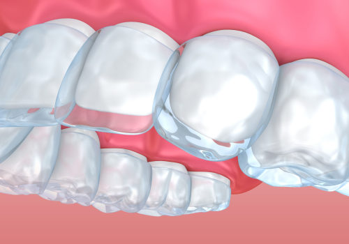 Will I Feel Discomfort While Wearing Invisalign Aligners?