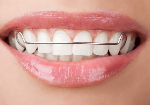 Maintaining Your Perfect Smile After Invisalign Treatment