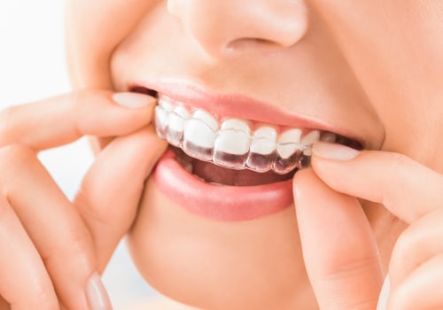 Does Invisalign Require Bonding? A Comprehensive Guide to Achieving the Perfect Smile